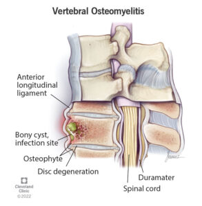 1726734013 22276 vertebral osteomyelitis spine