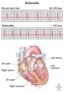 1726740314 22108 tachycardia illustration