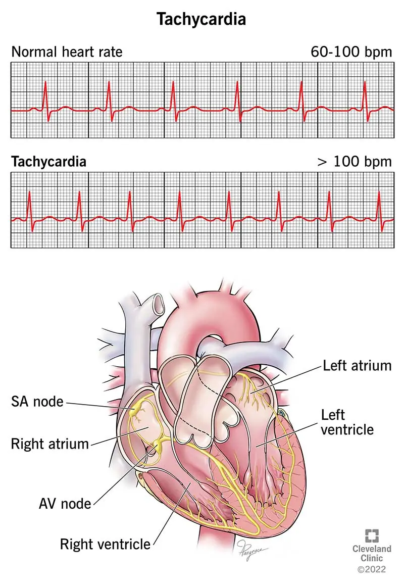 1726740314 22108 tachycardia illustration