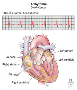 1726844731 16749 arrhythmia illustration