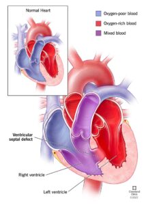 1726957517 17615 ventricular septal defect