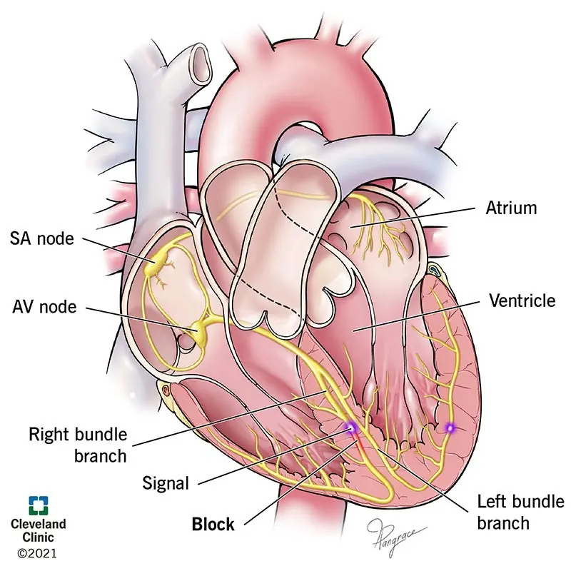 1727031618 21692 right bundle branch block illustration