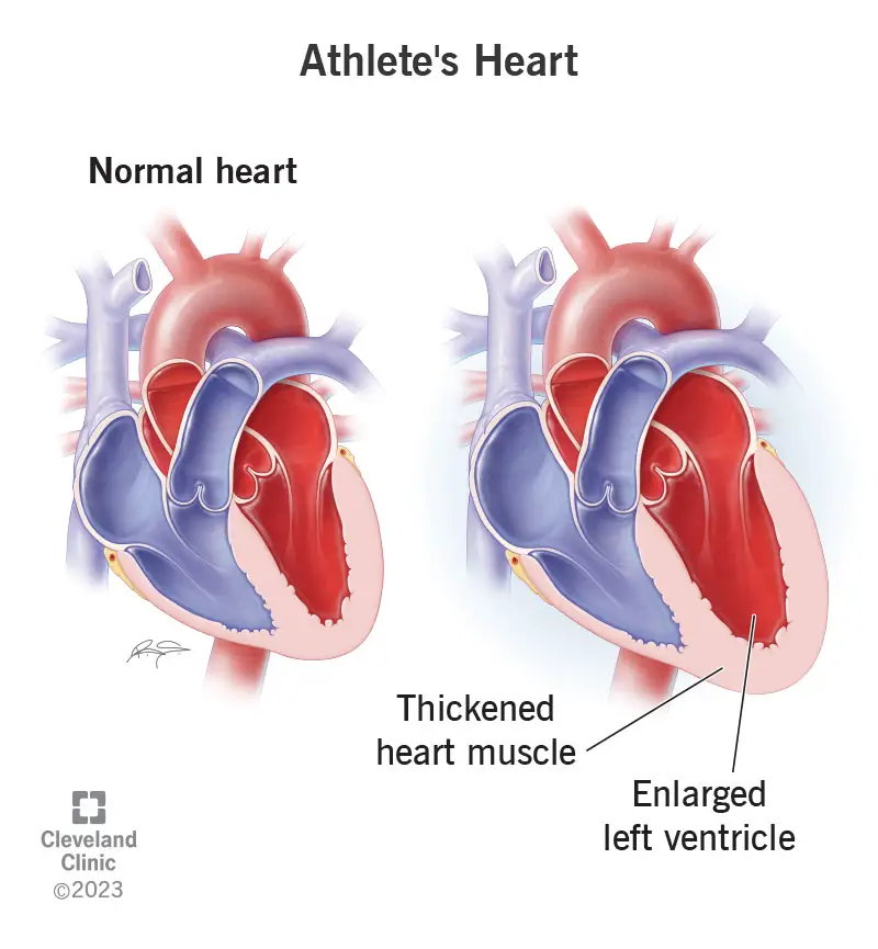 1727036115 23920 athletes heart