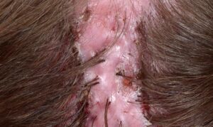 1727042415 22784 folliculitis decalvans