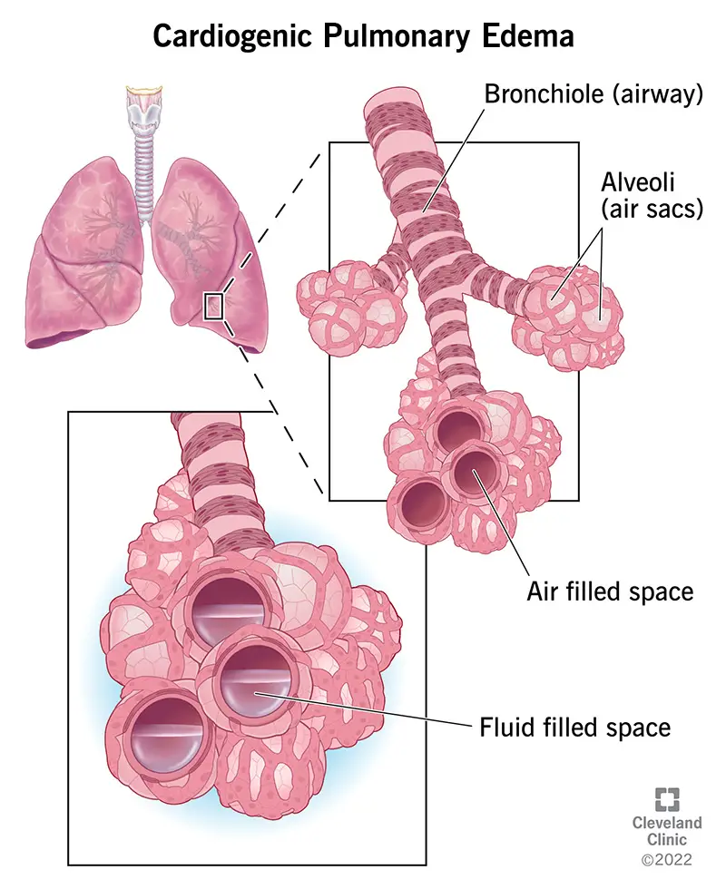 1727257516 22941 cardiogenic pulmonary edema