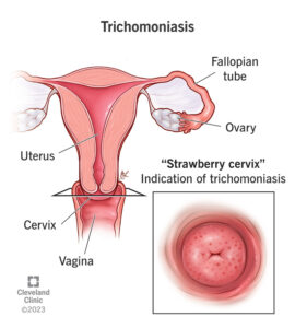 1727276416 4696 trichomoniasis