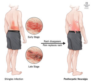 1727317842 12093 postherpetic neuralgia