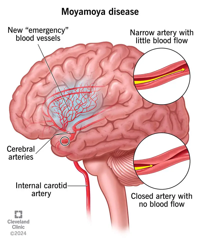 1727340617 17244 moyamoya disease