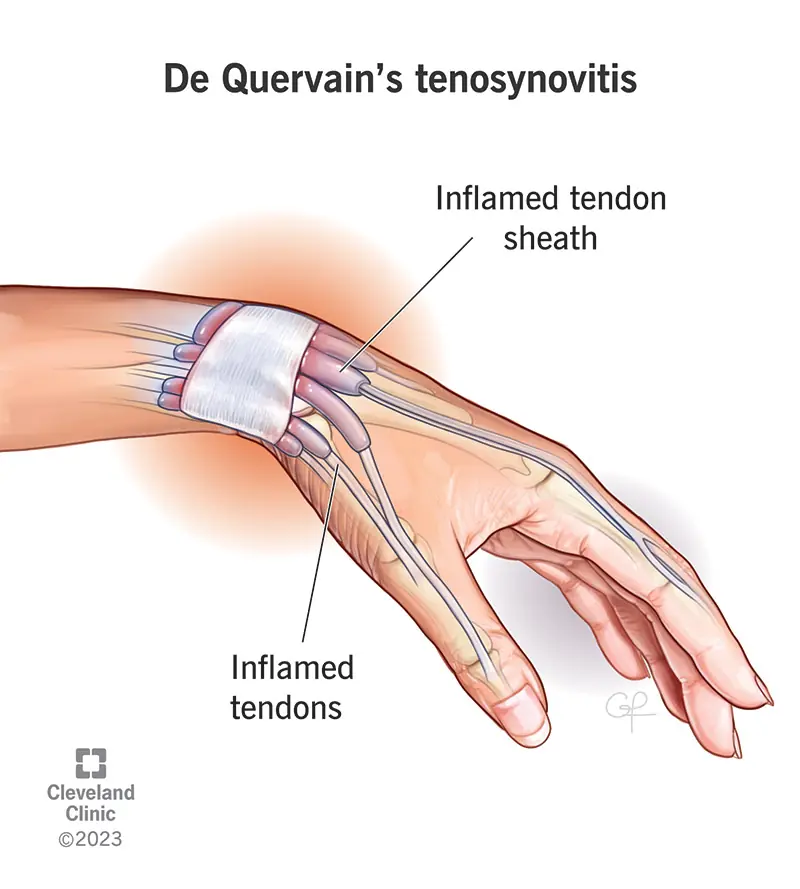 1727377520 10915 dequervains tendosynovitis