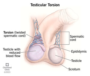 1727424617 15382 testicular torsion