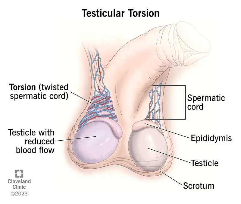 1727424617 15382 testicular torsion