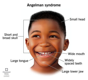 1727436917 17978 angelman syndrome