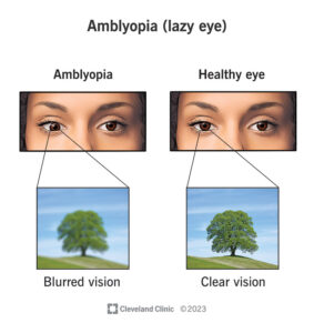 1727456417 10707 amblyopia lazy eye