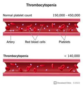 1727481017 14430 thrombocytopenia