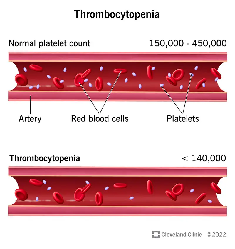 1727481017 14430 thrombocytopenia