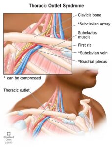 17553 thoracic outlet syndrome illustration.ashx