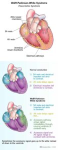 17643 wolff parkinson white syndrome