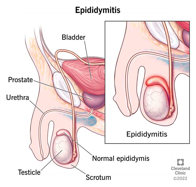 sveikas epididimis ir epididimitas