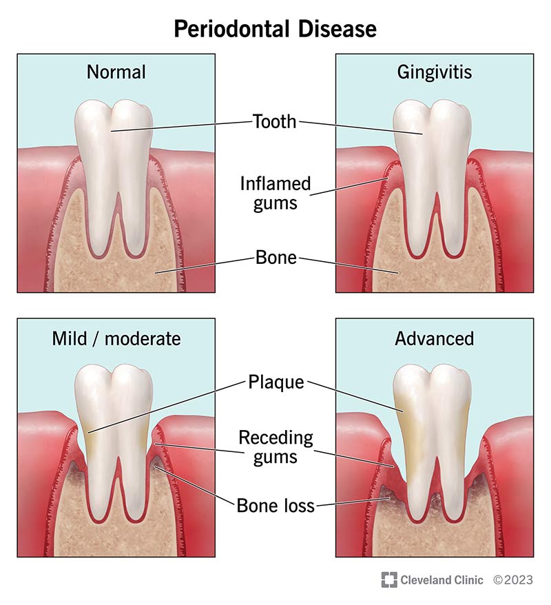 Periodonto ligos stadijos: gingivitas, lengvas/vidutinio sunkumo periodontitas, pažengęs periodontitas.