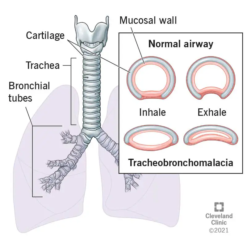 Trachėjos ir bronchų diagrama kairėje. Dešinėje – išsamiai apie tai, kaip tracheomalacija susiaurina trachėją ir uždaro kvėpavimo takus