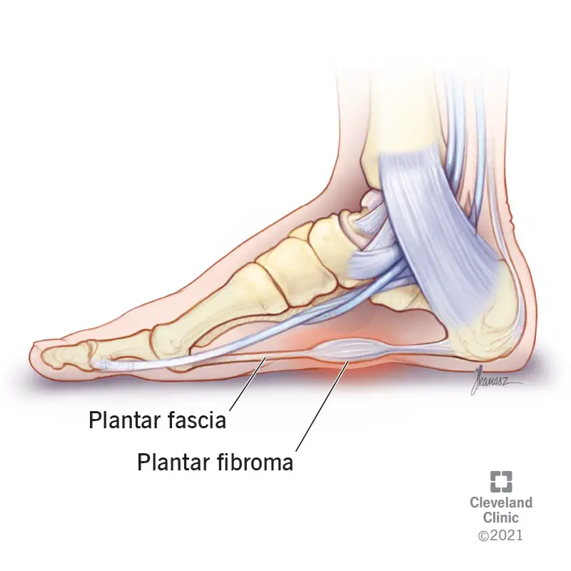 Padų fibroma, auganti ant pėdos skliauto.