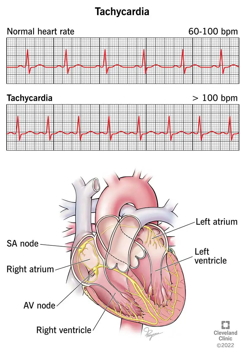 EKG su daugiau nei 100 dūžių per minutę (ramybės būsenoje) rodo tachikardiją.