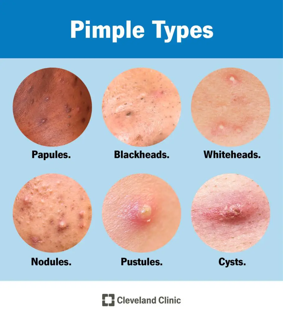 22468 pimples