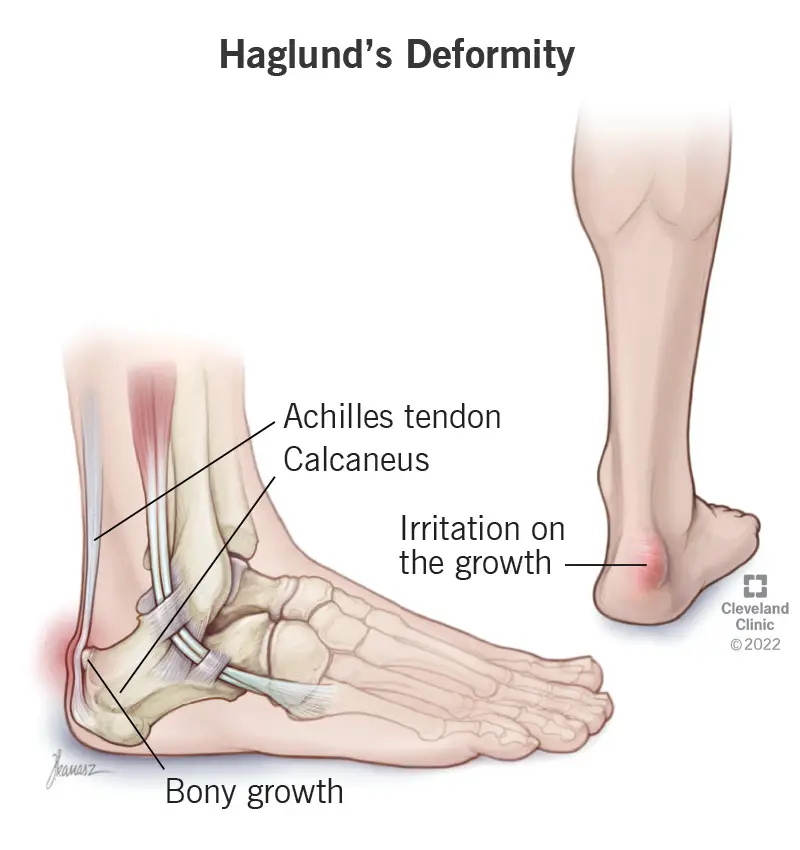 Haglundo deformacija sukelia kaulinį augimą ant kulno kaulo (calcaneus)