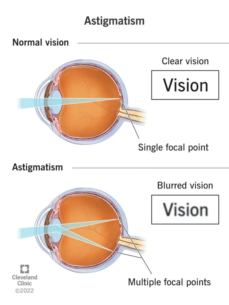 8576 astigmatism