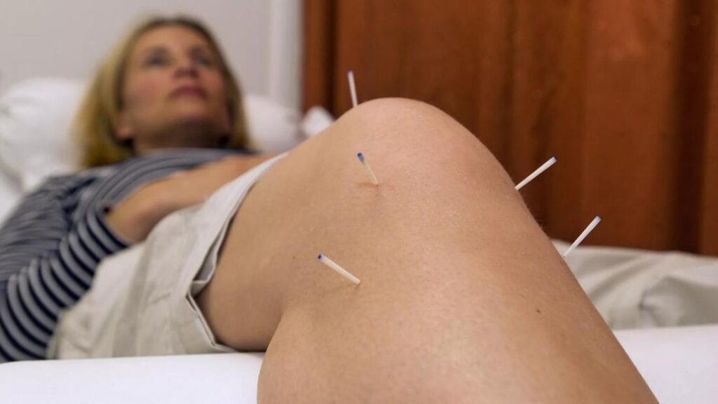 AcupunctureKnee jpg