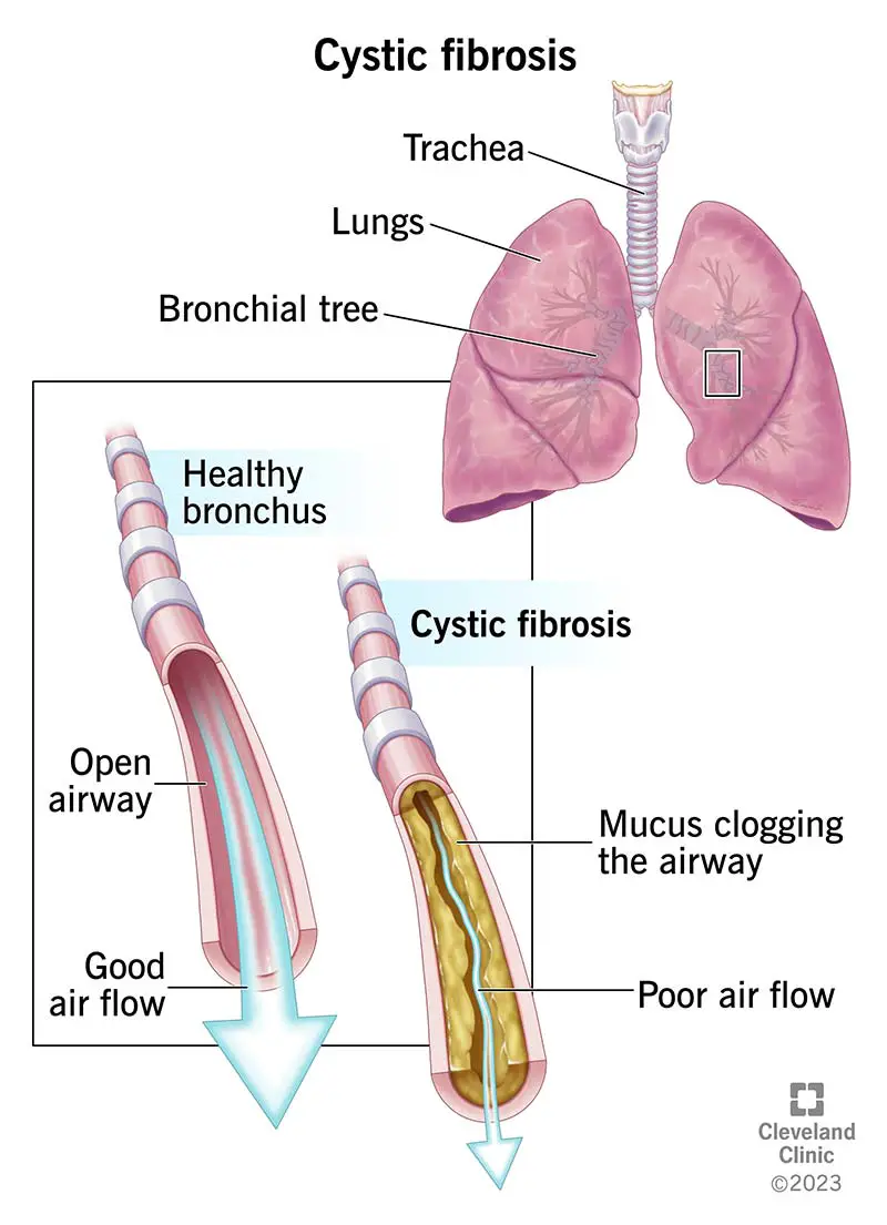 Sveiko broncho plaučiuose ir vieno su cistine fibroze vaizdas. Sergančiųjų CF storos gleivės riboja oro srautą.