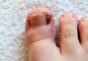 ingrownToenail 1165595353 770x553 jpg