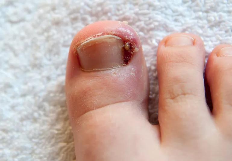 ingrownToenail 1165595353