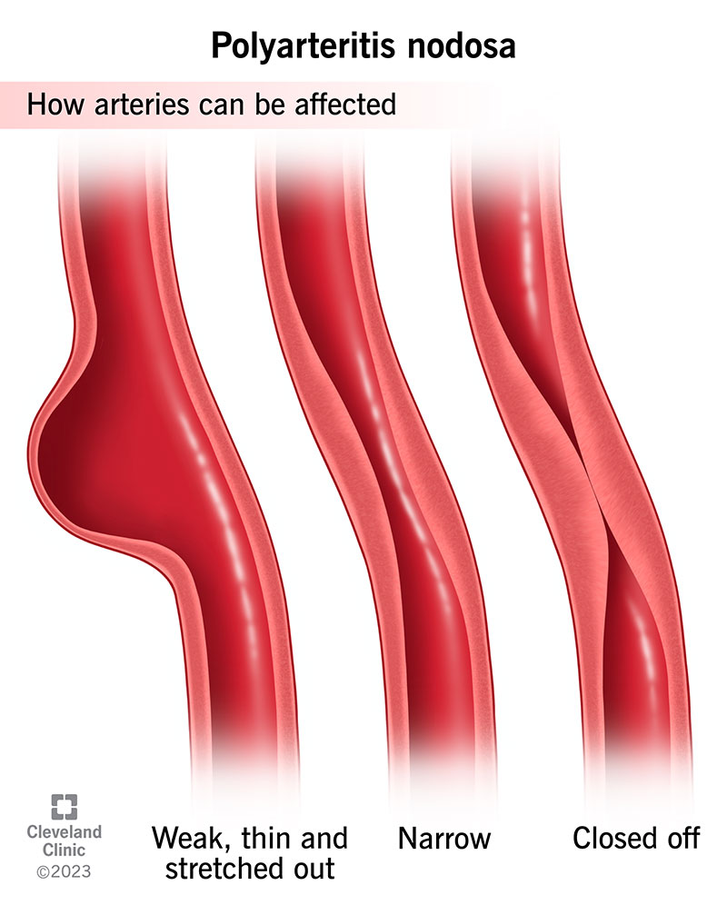 Mazginis poliarteritas uždega jūsų arterijas, todėl jos susiaurėja ir uždaromos