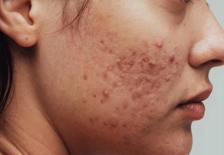 acne on face 1326434308 770x533 1 jpg