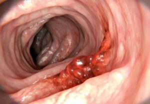 colonCancer 646161486 770x533 1 jpg