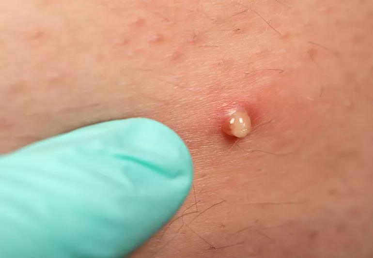 ingrown hair follicle butt 1289667581 770x533 1 jpg