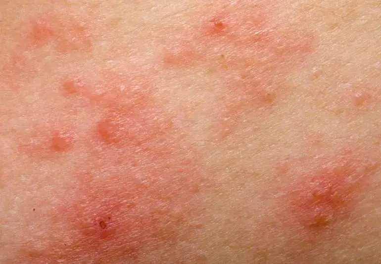 phtotoxicitySkinRash prevOnline 770x533 1 jpg