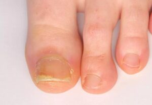 psoriaticArthritisToenails 1186515106 770x533 1 jpg