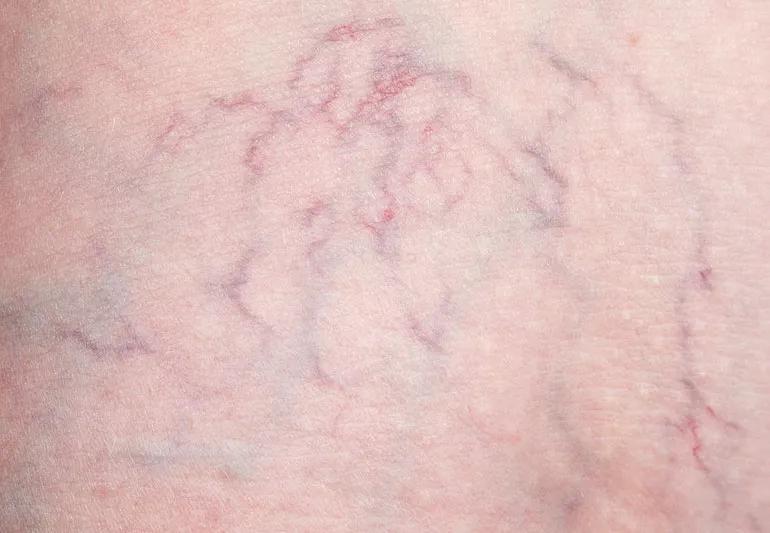 spider Veins on leg 184277101 770x533 1 jpg