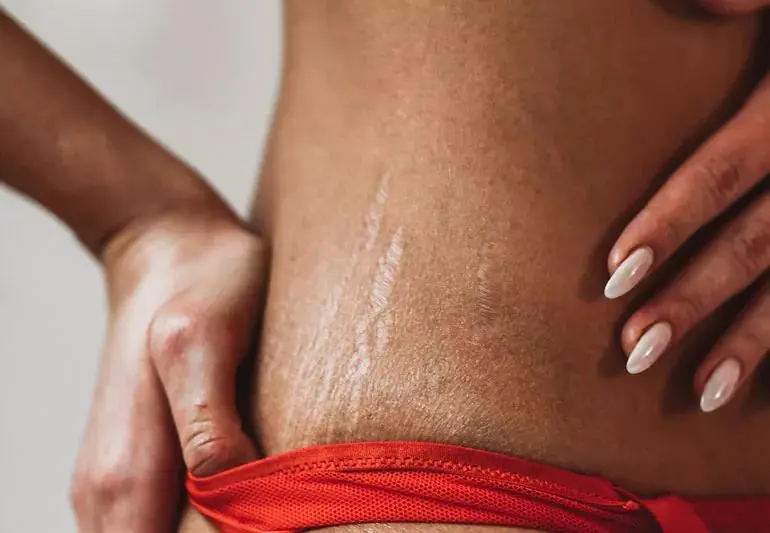 stretch Marks 1456026197 770x533 1 jpg