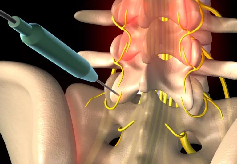 radiofrequencyAblation CMAP SaboM 770x533 1 jpg